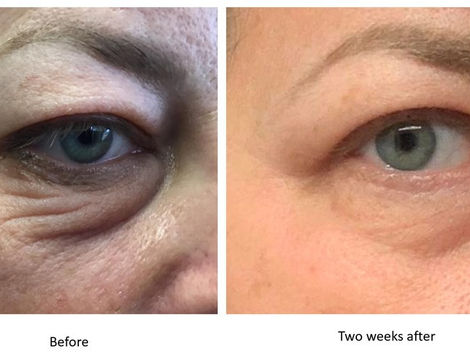 How Plasma Pen Treatment Enhances Skin Texture Insights for Dubai Residents