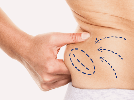 Preparing for Your Tummy Tuck in Dubai Essential Tips and Guidelines