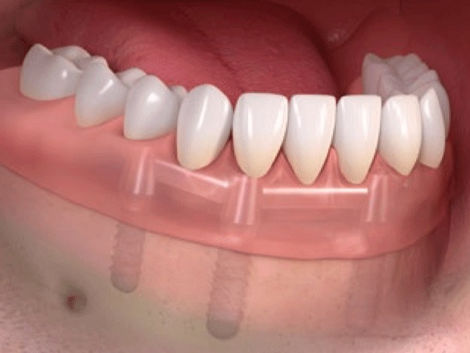 Dental Implant Surgery What to Expect in Dubai
