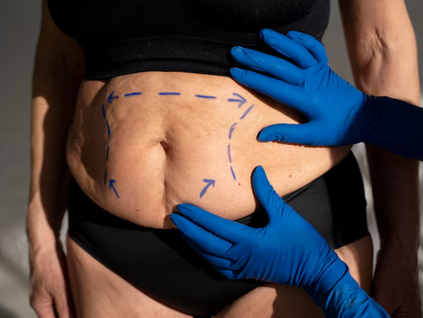 Is Tummy Tuck in Dubai Right for You? A Comprehensive Overview