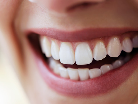 Understanding the Process of Composite Veneers in Dubai Clinics