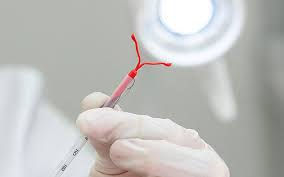 Factors Affecting Mirena IUD Insertion Cost in Dubai