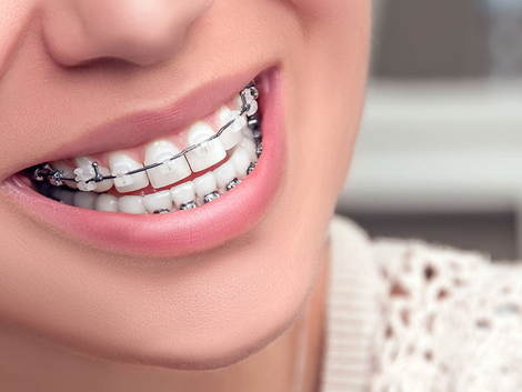Insurance Coverage for Dental Braces in Dubai What You Need to Know