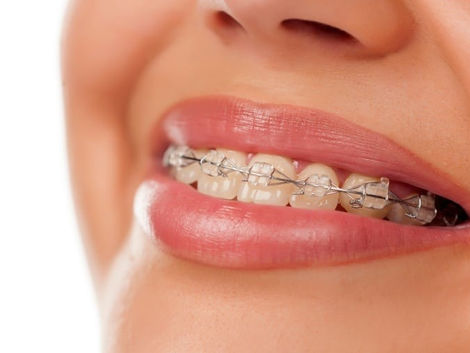 Lingual Braces Cost in Dubai What to Expect