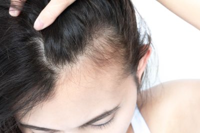 Customized Hair Loss Treatment Plans Finding the Right Fit in Dubai