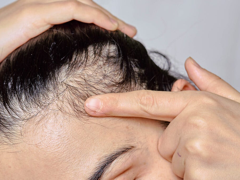 Innovative Hair Loss Treatments in Dubai What’s Trending?