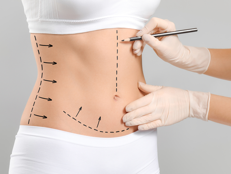 The Benefits and Risks of Tummy Tucks Insights for Dubai Residents