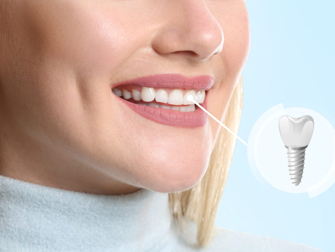 Insurance Coverage for Dental Implants in Dubai