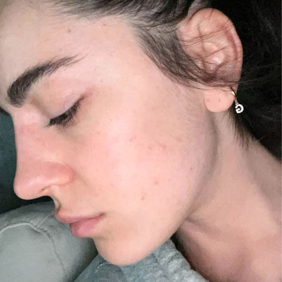 Miniatura: ACNE