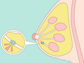 乳癌年輕化趨勢下的挑戰：三陰性乳癌與好發族群解析