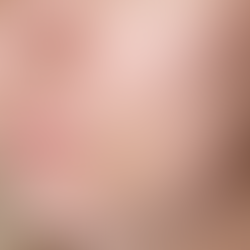 Aknenarben behandeln: Welche Methode wirklich hilft und wann Hyaluron, Laser oder Morpheus8 sinnvoll sind