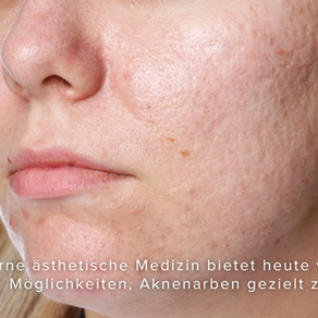 Aknenarben behandeln: Welche Methode wirklich hilft und wann Hyaluron, Laser oder Morpheus8 sinnvoll sind