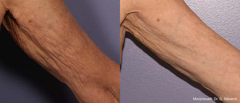 Morpheus 8 vorher/nachher Körperstraffung Arme