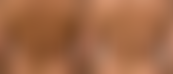 Morpheus 8 vorher/nachher Körperstraffung Rücken, Lovehandles, Bauch