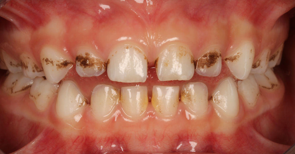 Dents atteintent de taches noires type black stains