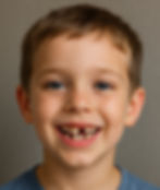 enfant avec une dent expulsée 
