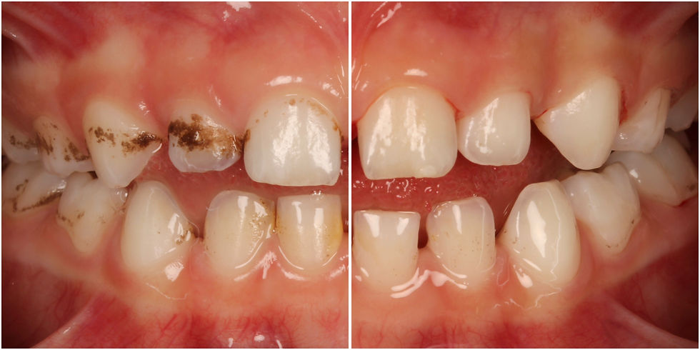 Effet de l’aeropollisage sur les dents atteintent de black stains