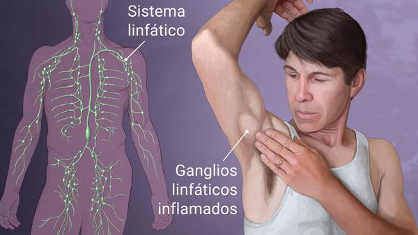 La imagen, muestra el sistema linfático y un ganglio inflamado