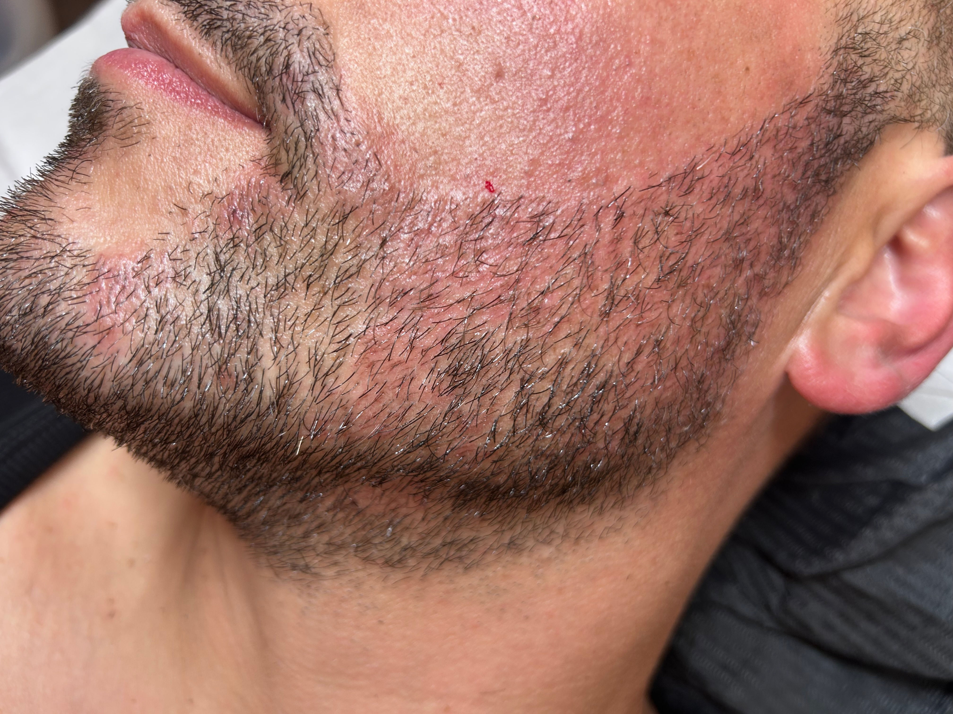 Tricopigmentation: comblement de barbe