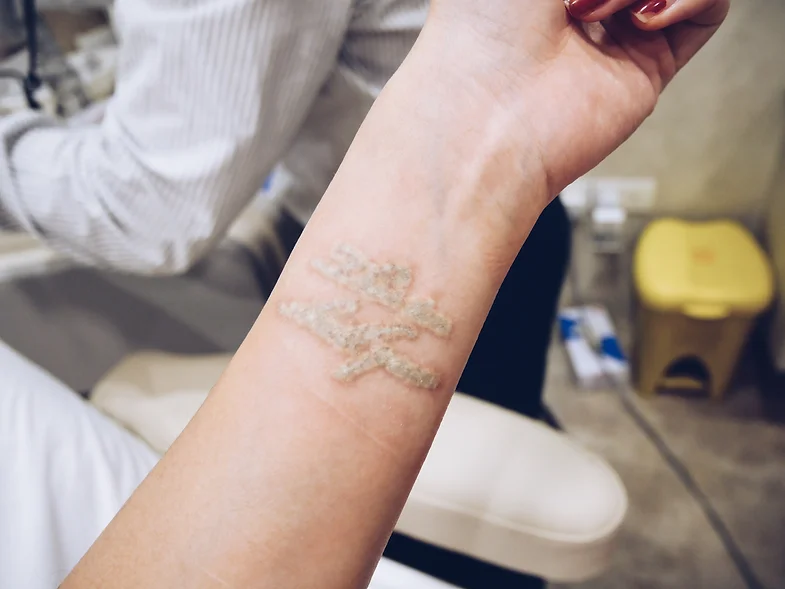 4th tattoo removal procedure model travel pancakepixie 4th tattoo removal procedure model travel pancakepixie