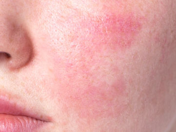 Hautgesundheit im Fokus: Couperose und Rosazea erkennen und verstehen