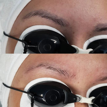 Tattoo Removal Bonn