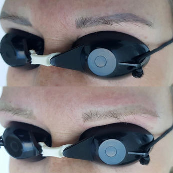 Tattoo Removal Bonn