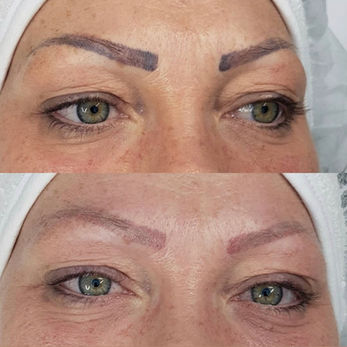 Tattoo Removal Bonn