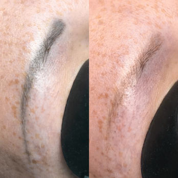 Tattoo Removal Bonn