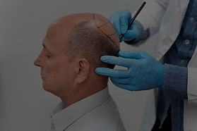 mature-man-going-through-follicular-unit