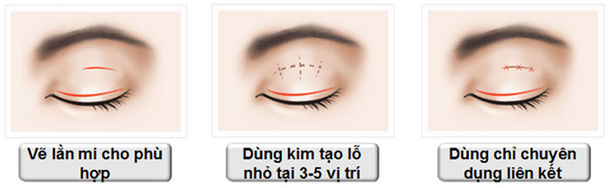 Chuyên gia trả lời bấm mí có phẫu thuật không