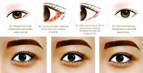 Tạo khóe mắt có sửa mắt xếch được không?