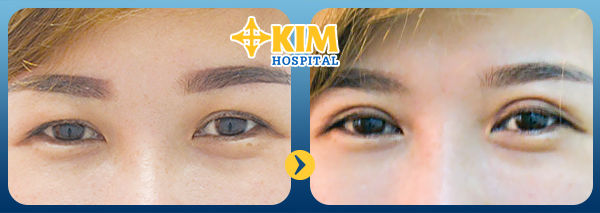Tìm hiểu phương pháp nhấn mí mắt chỉnh mí lệch