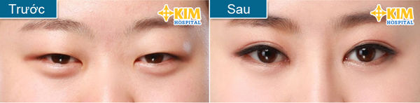 Xu hướng cắt mắt hai mí ở nam giới (4)