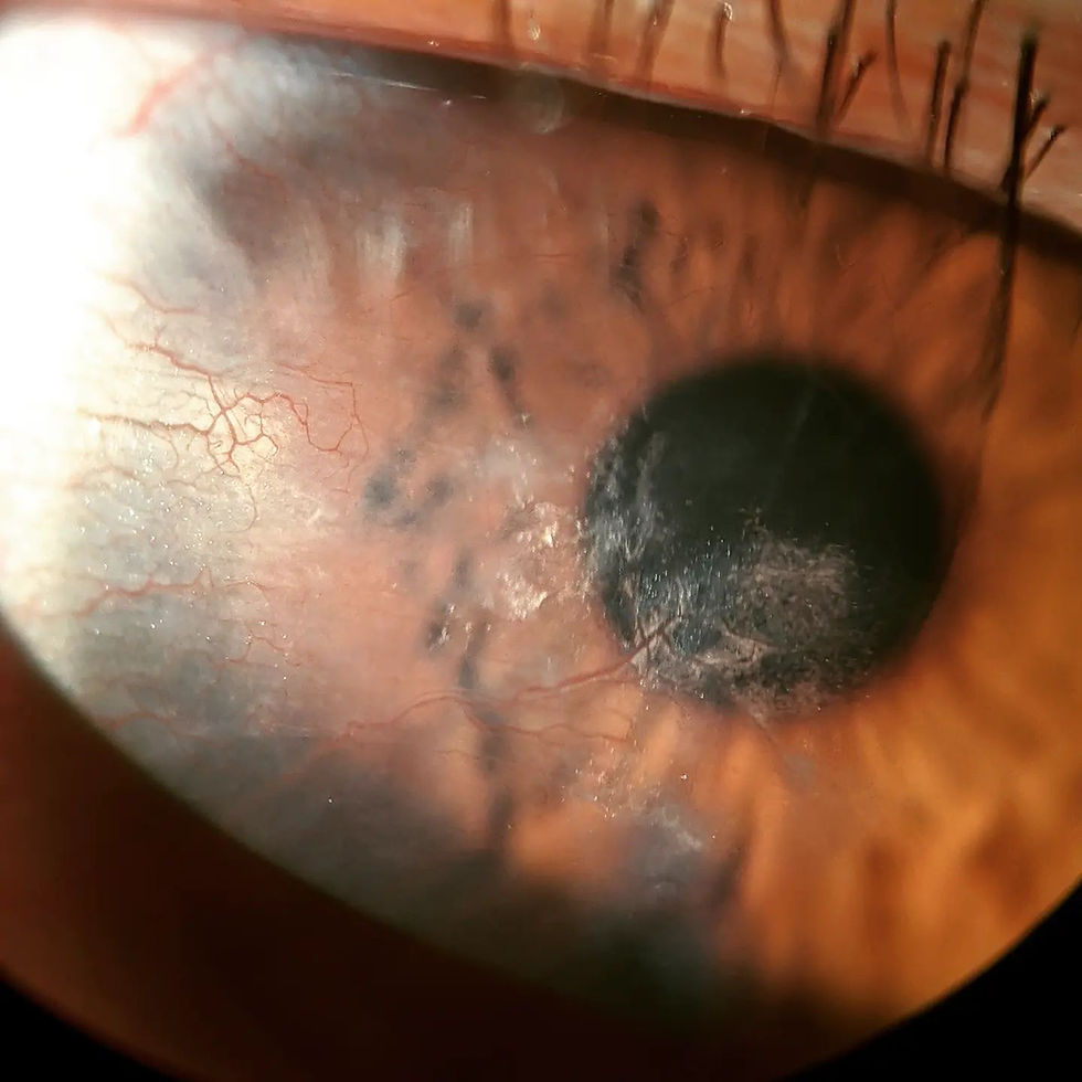 Neovascularización Corneal