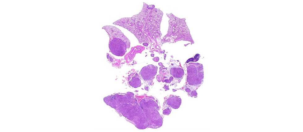 Mouse lung histopathology showing multifocal tumors under low magnification