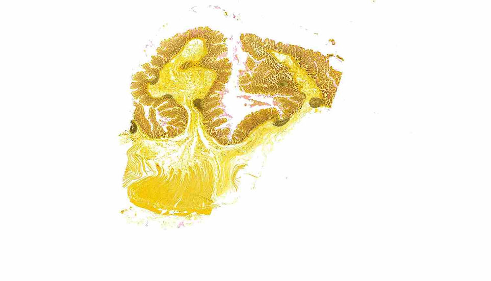 Mucicarmine Stain