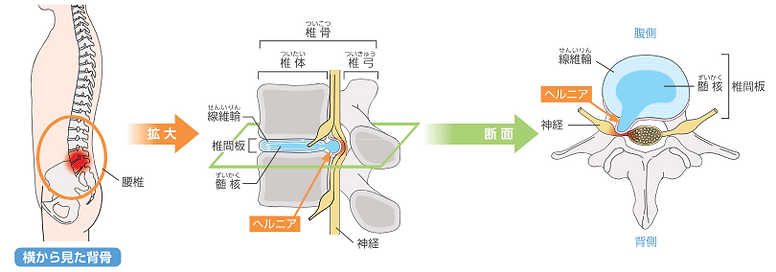 ヘルニアnoimeage.webp