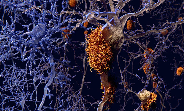 Amyloid-plaques.jpg