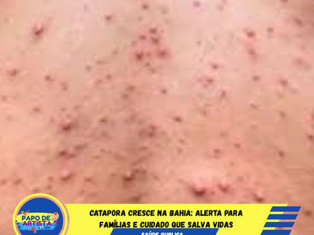 Catapora cresce na Bahia: alerta para famílias e cuidado que salva vidas