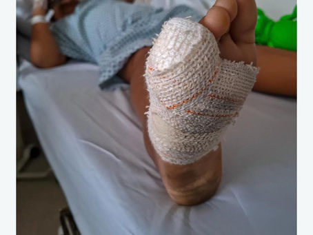 Crianças são mutiladas em brinquedo de condomínio no Litoral Norte da Bahia