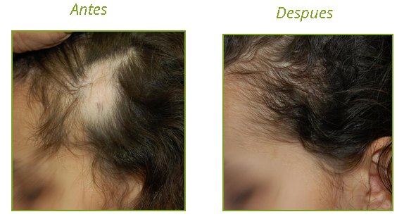 alopecia