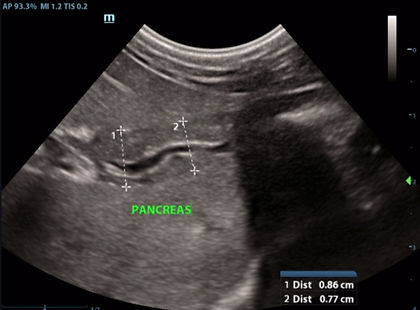 Ultrasound Pancreas