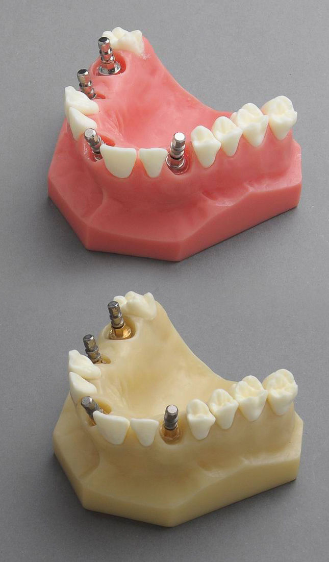 Thumbnail: Upper Jaw Implant Model