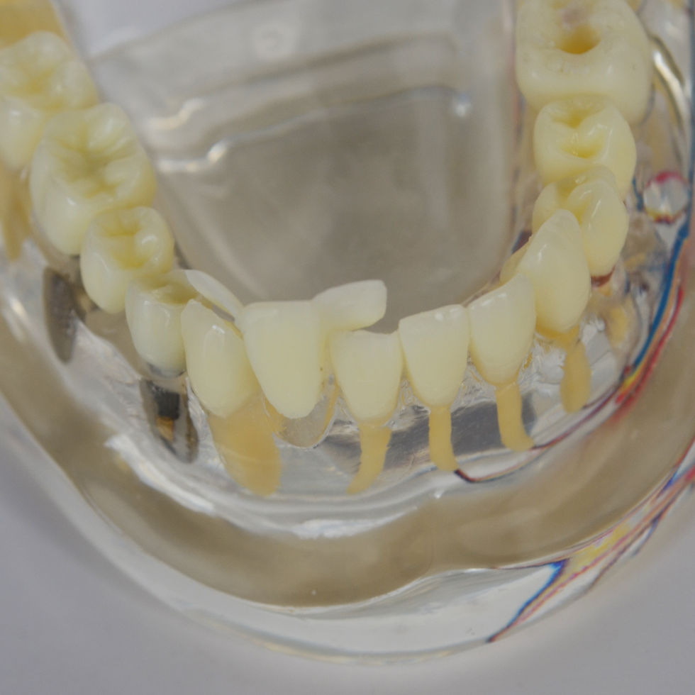 Thumbnail: General Dental Model with Implant Restoration Pathology