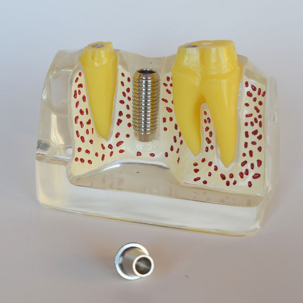 Thumbnail: Implant Analysis Model