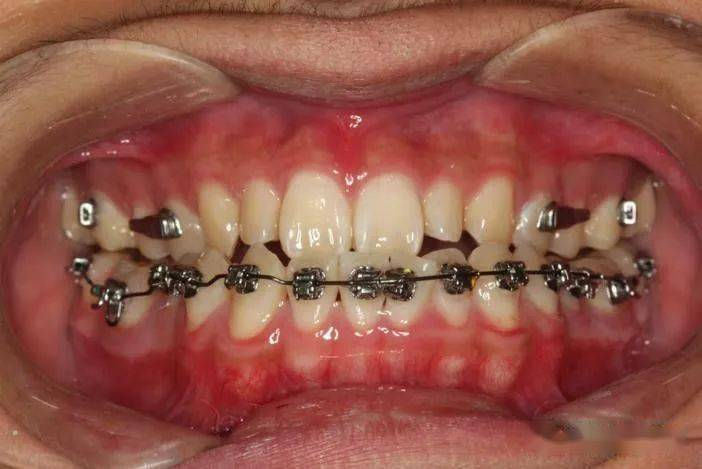 Thumbnail: Molar Pusher