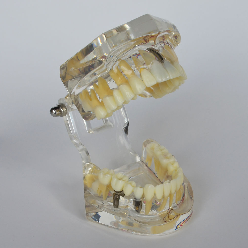 General Dental Model with Implant Restoration Pathology