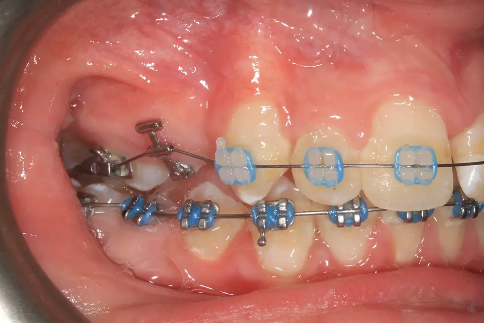 Thumbnail: ABRAM Eruptor Button Tube