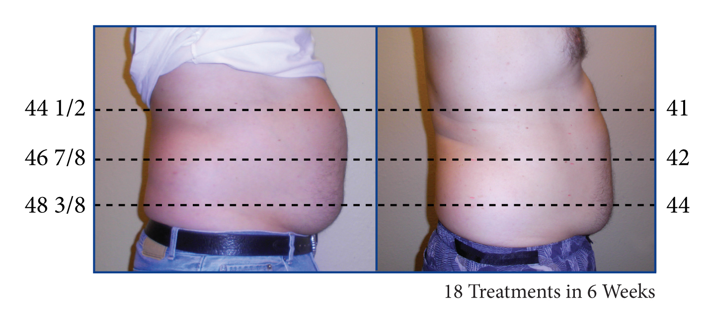 LaserLike Lipo El Segundo Family Chiropractic